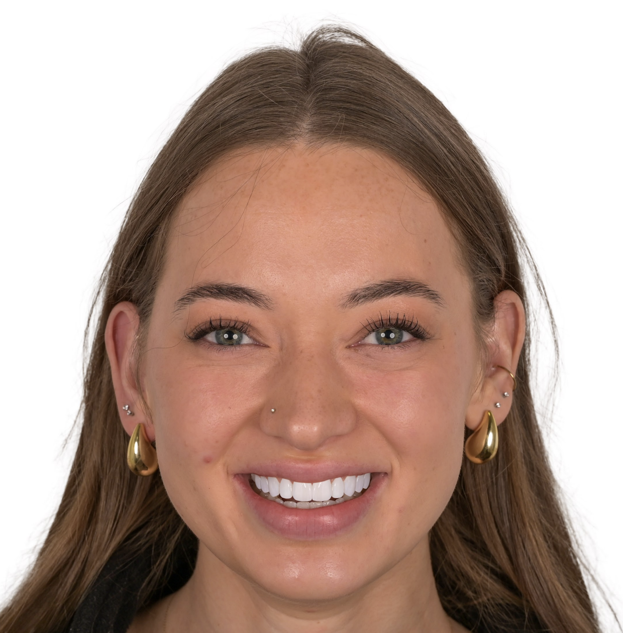 Young patient smile after digital smile design showing perfected tooth alignment and brightness