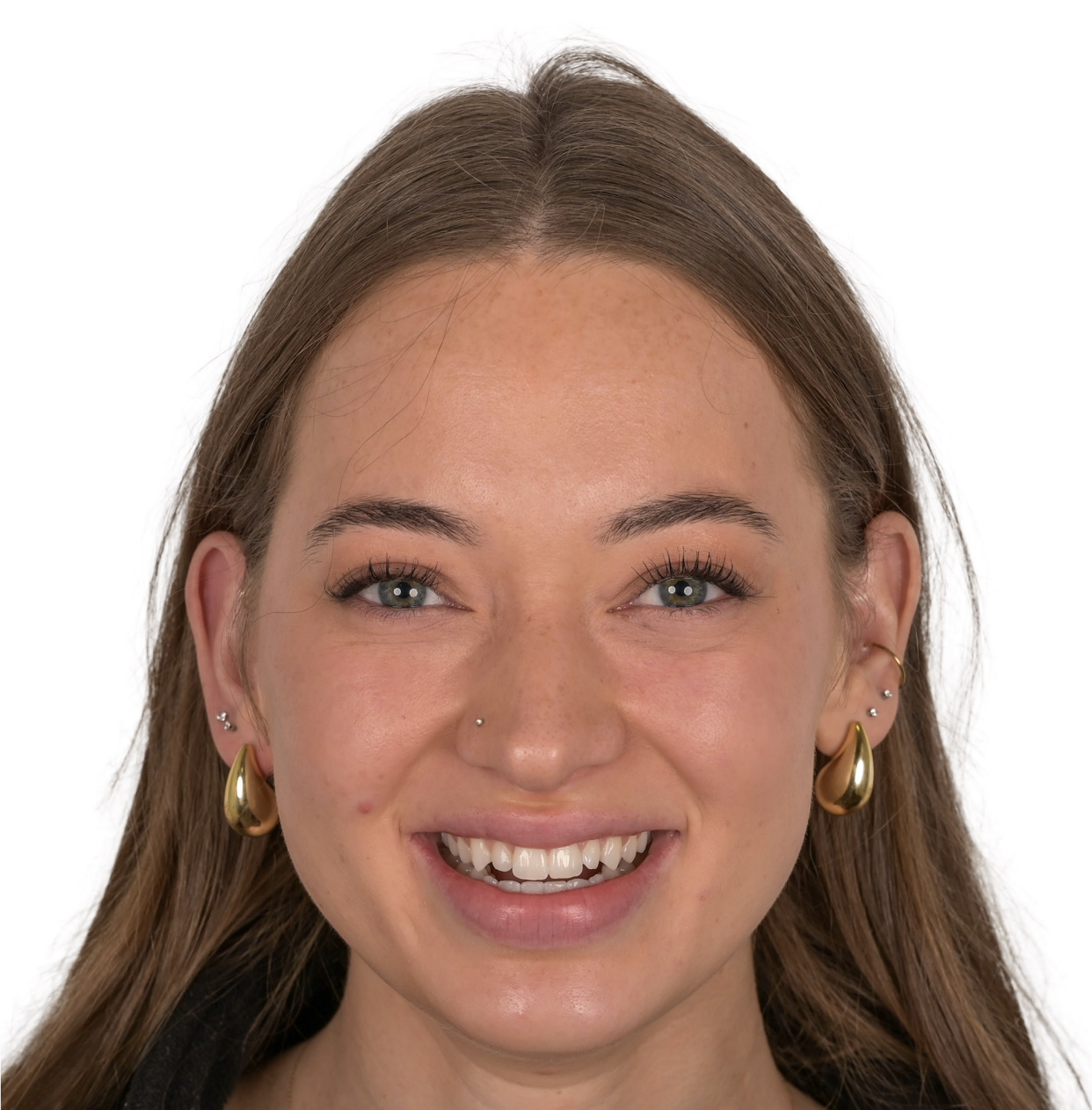 Young patient smile before digital smile design showing minor tooth irregularities