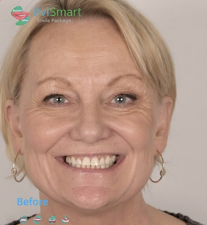 Patient smile before digital smile design treatment showing worn and discolored teeth